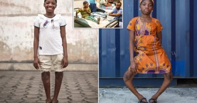 Girl With Severely Bowed Legs Gets Life-Changing Surgery To Correct Her Deformity
