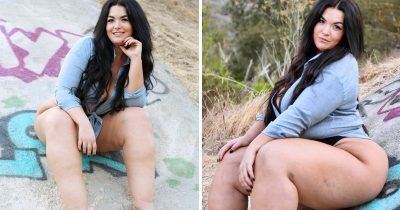 'I've Extreme Swelling In My Legs, But I Stopped Caring What Trolls Have To Say'